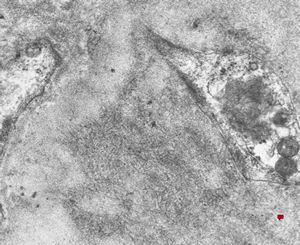 F,40y. | fibrillary glomerulopathy (amyloid negative) F,40y. | fibrillary glomerulopathy (amyloid negative)